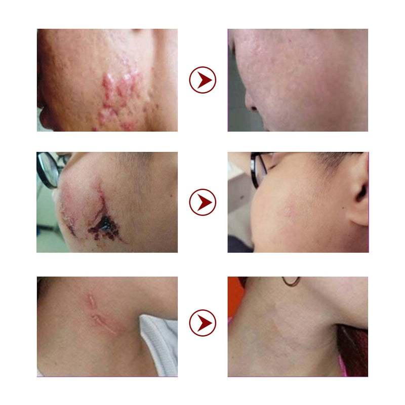 Acne Scar Removal Cream