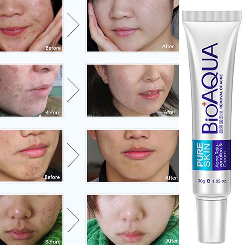 Gel Anti-Acne Treatment Face