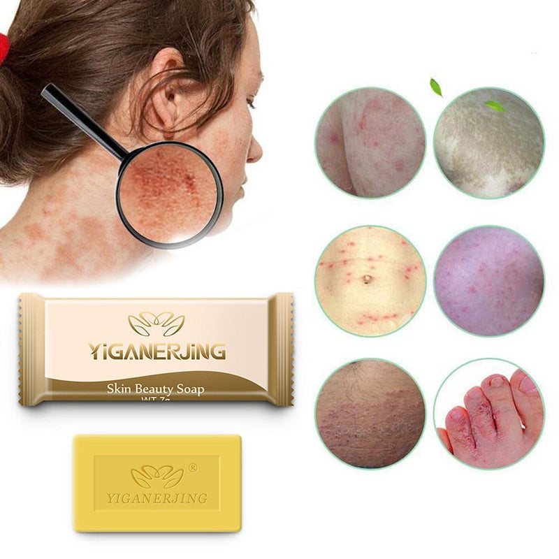 Anti Acne Soap Acne Treatment