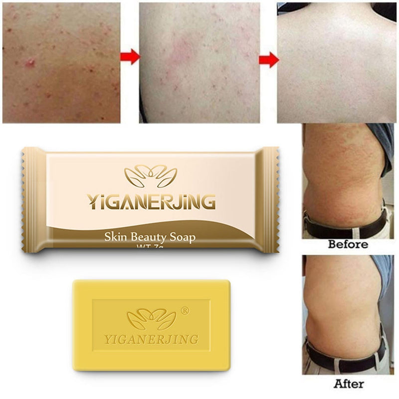 Anti Acne Soap Acne Treatment